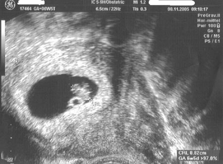 На седьмой неделе беременности УЗИ показывает не только рост эмбриона, но и...