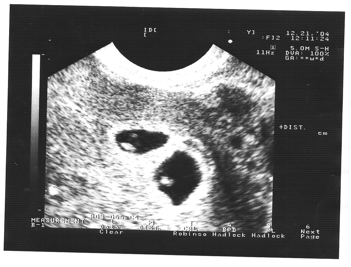 Узи в 7 недель беременности фото