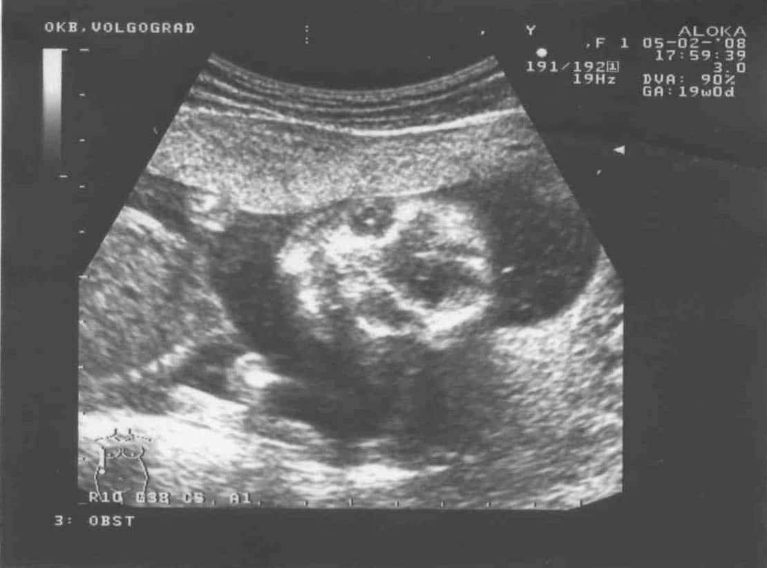 18 недель беременности фото плода и размер