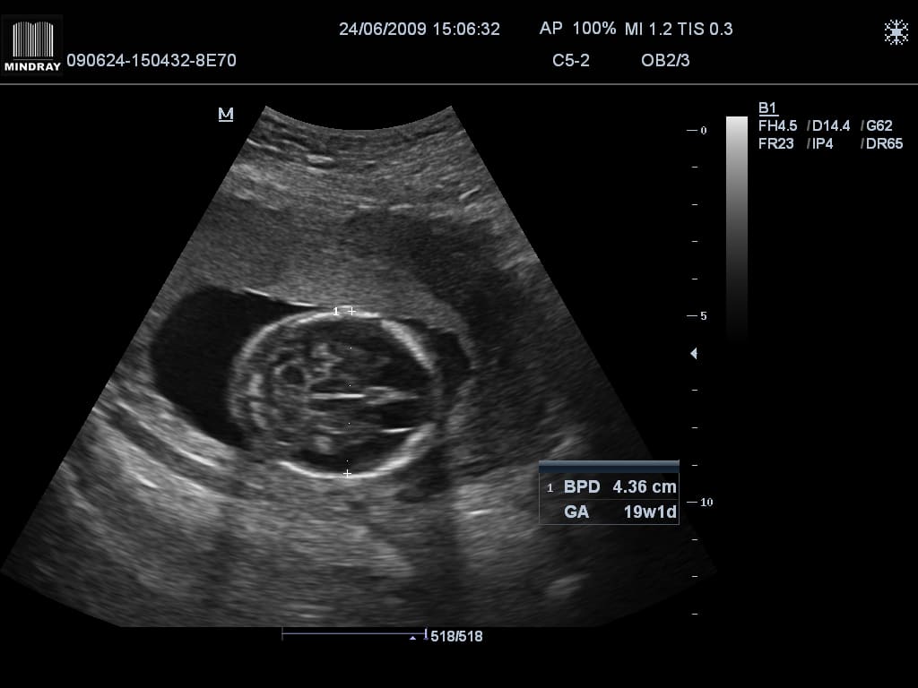 19 недель воды. Снимок УЗИ на 19 неделе беременности. Малыш на 19 неделе беременности УЗИ. УЗИ ребенка на 19 неделе беременности на УЗИ. 19 Недель беременности фото плода на УЗИ.