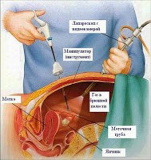 лапароскопия