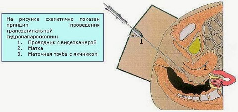 ТГЛ или трансвагинальная гидролапароскопия