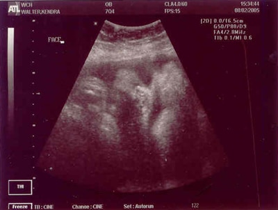 40 недель состояние. УЗИ на 40 неделе беременности. УЗИ при беременности 40 недель. УЗИ 40 недель беременности фото.