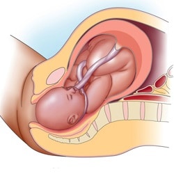 Обвитие пуповиной на 32 неделе беременности
